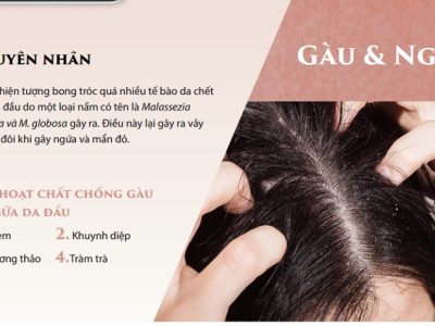 Gàu là nguyên nhân gây ngứa rụng tóc